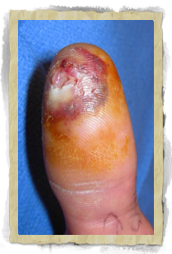 Felon Infection